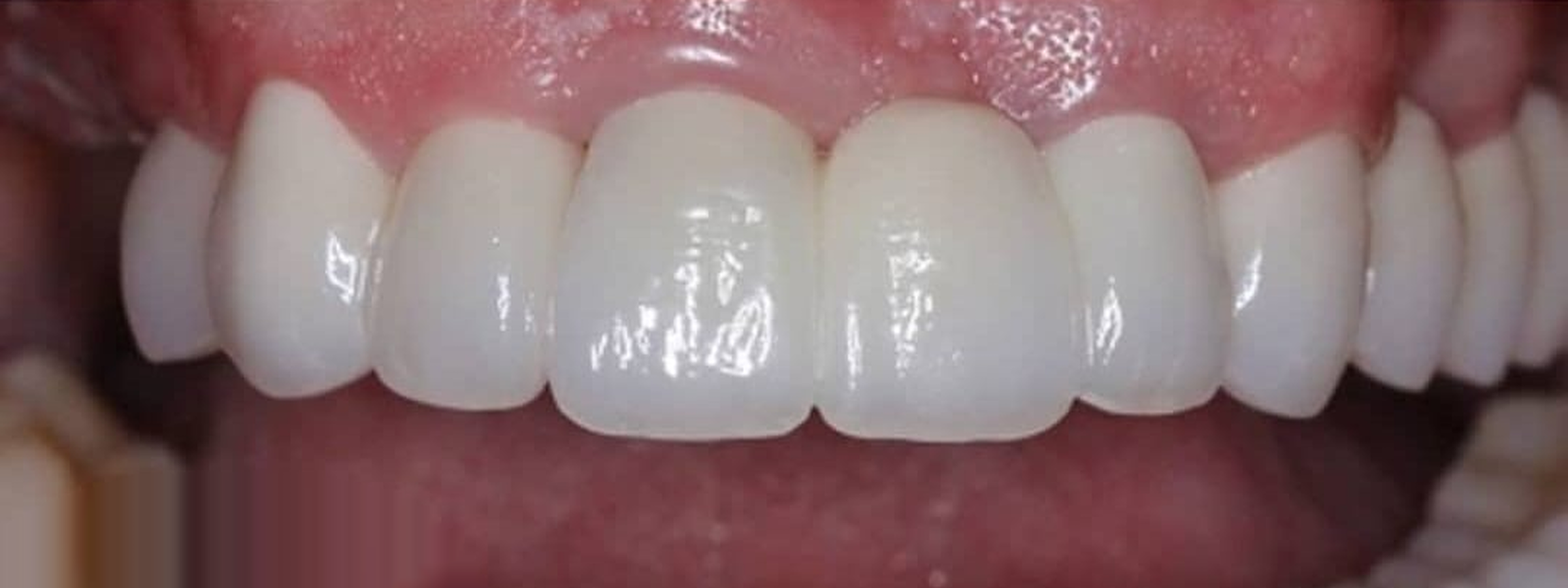 Crowns treatment result after treatment
